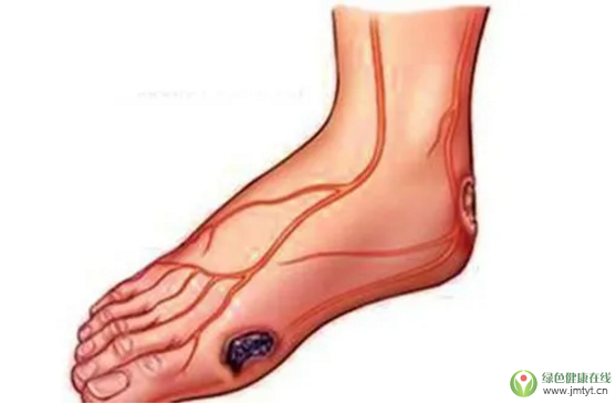 糖尿病足怎么能治療好.png 糖尿病足怎么能治療好.png